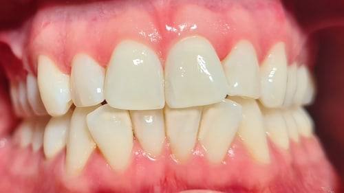 bleaching_zaehne_komprimiert